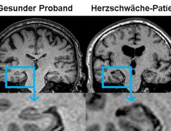 Verminderte Hirnleistung bei schwachem Herz 